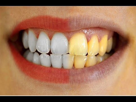 Whiten Teeth in photoshop