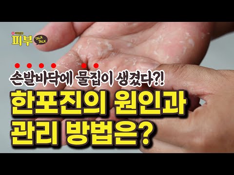 '습진' 아닙니다! 손발에 물집이 생기는 한포진 ‘이렇게’ 관리하세요! - 박치영의 피부 톡톡 #145