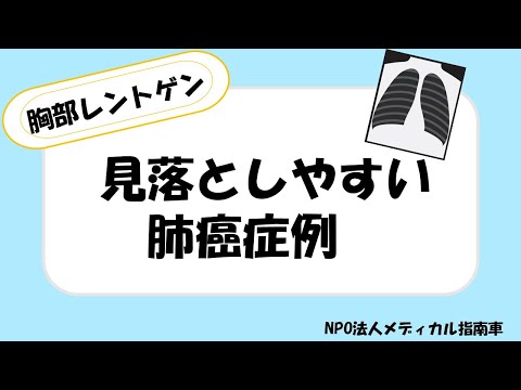 見落としやすい肺癌症例ー胸部レントゲンー