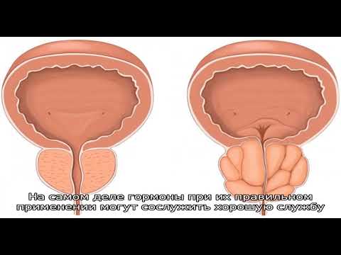 Лечение аденомы простаты без операции препаратами и иными средствами