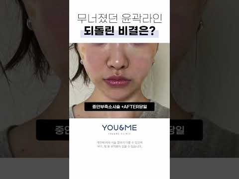 강력하고 오래 지속되는 리프팅 시술을 찾는다면? #중안부축소리프팅#실리프팅후기