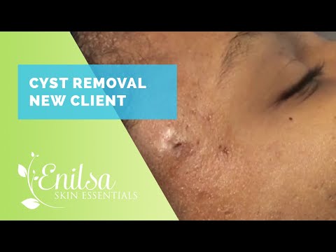 Cyst Removal New Client