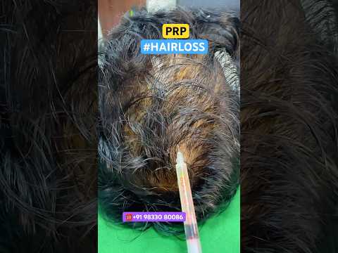 Best Hair Loss Treatment #hair #prp #haircare #ytshorts #shorts