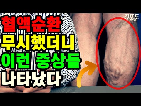 혈액순환 안될때 반드시 나타나는 증상