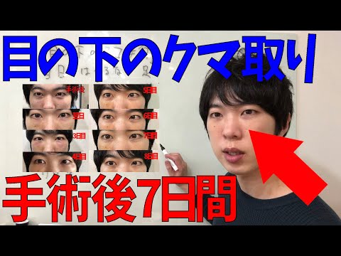 目の下のクマ取り手術後、7日間の経過を紹介します！湘南美容外科で目のクマたるみ取り手術しました。ダウンタイム