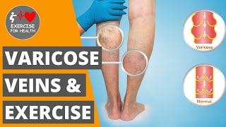 The effects of exercise on Varicose Veins