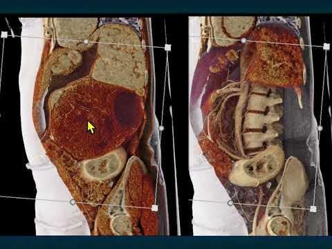 CT of the Large (greater than 4cm) Adrenal Mass: Pearls and Pitfalls - Part 3