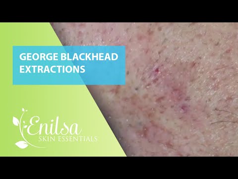 Blackheads Extractions on George