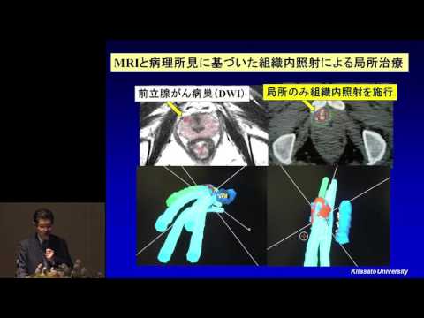 前立腺がん治療アップデート：早期･進行がんの最新治療解説　佐藤威文氏