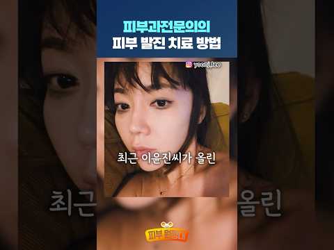 빨갛게 부푸는 피부 발진, 치료 방법은?! #shorts #발진 #반점