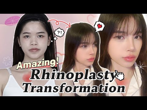 My fabulous rhinoplasty journey... | Lilo's plastic surgery journey at BRAUN!