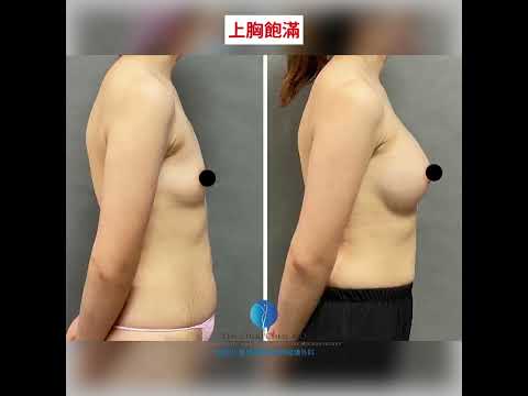 柔滴隆乳5個月追蹤