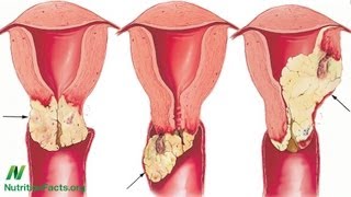 Why Might Vegetarians Have Less HPV?