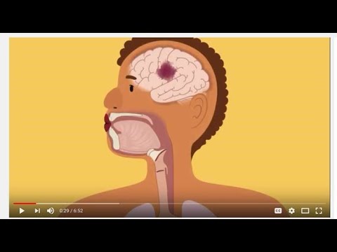 Engolir e Comunicação após um AVC-Swallowing and Communication after Stroke (Portuguese)