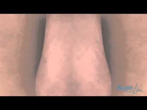 Vasectomy Surgey - Reversing the Surgery