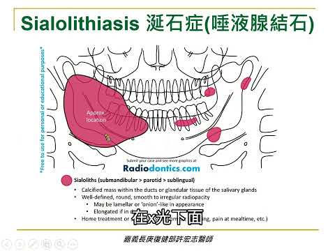 影響吞嚥的原因: 嘴巴裡的結石-涎石症