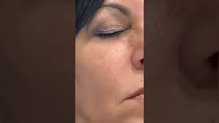 Under Eye Fillers by Restylane & Belotero at Plantation Med Spa, Florida - Rejuvenate Your Look!