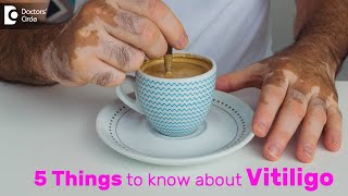 Vitiligo: Types, Symptoms, Causes, Treatment & Recovery - Dr. Divya Sharma | Doctors' Circle