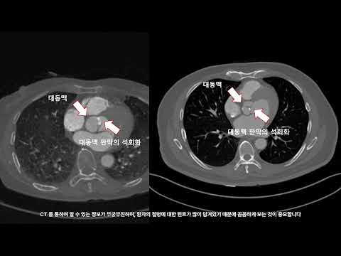 흉통이 있는 환자에서 놓지지 말아야 할 질병들 (CT를 중심으로)