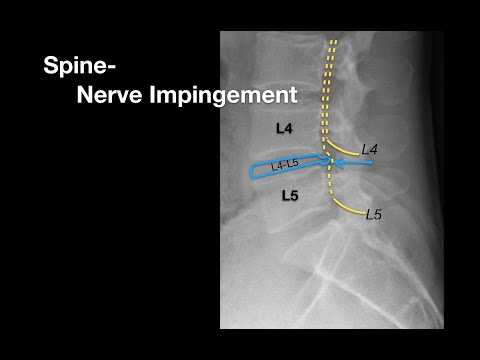 Spine Nerve Impingement