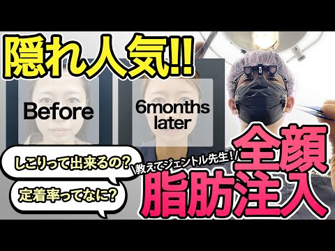 自分の脂肪注入で若返り☆アラフォー女性、顔面脂肪注入し放題の経過☆#脂肪注入 #若返り美容 #眉下切開