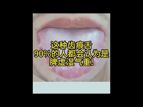 这种齿痕舌 90%的人都会认为是 脾虚湿气重!