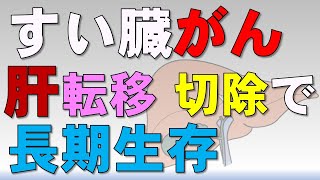 すい臓がん肝転移を切除後の長期生存例：症例報告