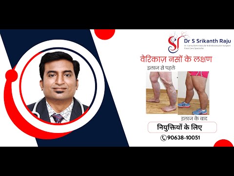 वैरिकाज़ नसों के लक्षण | डॉ.श्रीकांत राजू | वैस्कुलर & एंडोवास्कुलर सर्जन