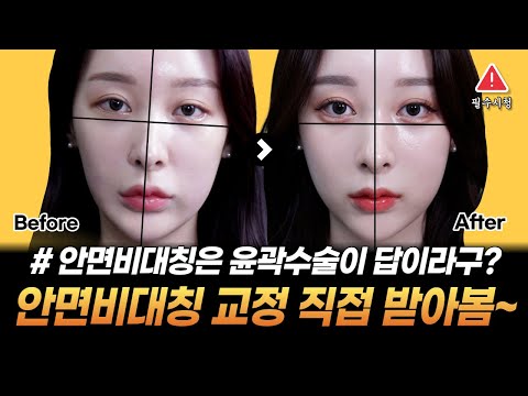 [안면비대칭] 비용, 위험부담으로 못하는 윤곽, 양악수술 말고❗ 피부과 시술로만 교정 성공 찐 후기❗