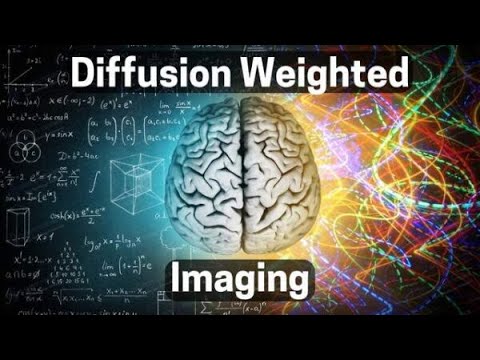 DWI MRI  for MS, Hydrocephalus and Cancer (Diffusion Weighted Imaging)