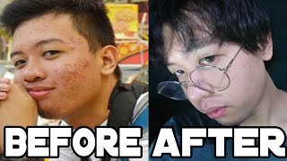 NEVER GET PIMPLES AGAIN!! (10 TIPS AND TRICKS TO AVOID GETTING PIMPLES)