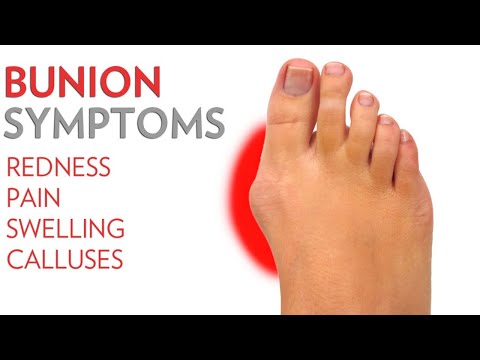 How to Get Rid of Bunions-Can You Treat Them Naturally?