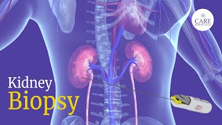 Kidney Biopsy: How it is Done? I Kidney Biopsy after transplant I