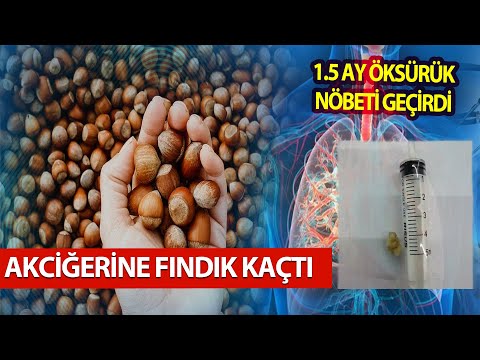 1.5 Ay Öksürük Nöbeti Geçirdi.. Akciğerinde Fındık Çıktı