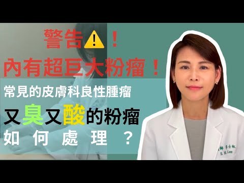 粉瘤手術診所台北熱門影片，快來看看粉瘤手術診所台北！