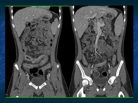 CT Evaluation of Suspected SBO: State of the Art 2024 - Part 4