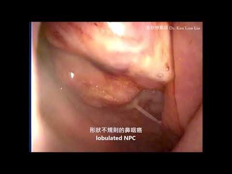 鼻咽癌 Nasopharyngeal Cancer , NPC