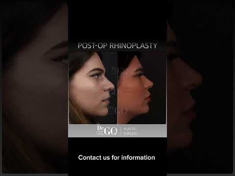 Before and after rhinoplasty - Dr Guncel Ozturk #beforeandafter #drgo #rhinoplastyturkey #burun