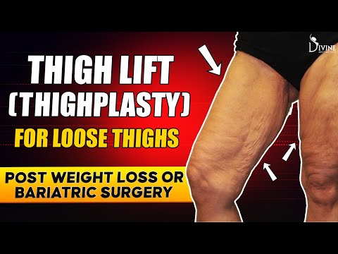 Thighplasty or Thigh Lift : Treatment for Sagging Thighs Post Weight Loss/Bariatric Surgery