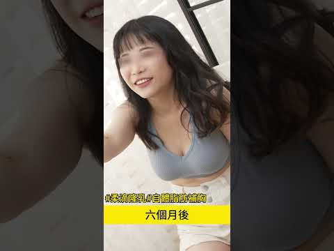 柔滴隆乳合併自體脂肪隆乳讓上圍激增的豐胸隆乳手術心得分享 台北教主