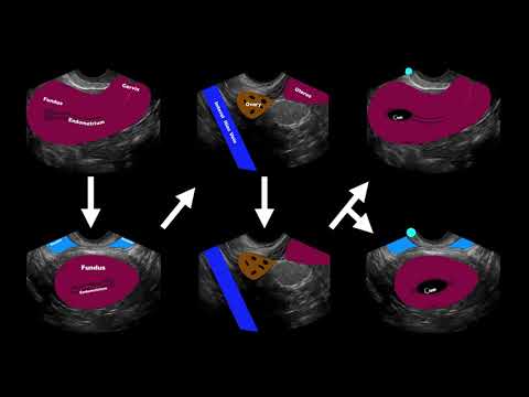 POCUS: 1st Trimester Pregnancy -  Case 5 - Complex adnexal mass