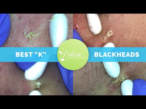 "K's" Best Blackhead Extraction Compilation Part #1