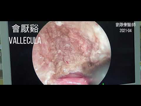 打鼾， 睡眠呼吸中止症， 內視鏡微創手術 Endoscopic minimally invasive surgery for osas by coblator