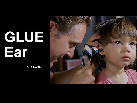 Glue Ear - it Management by Dr. Alice Siu on 10 Aug 2022