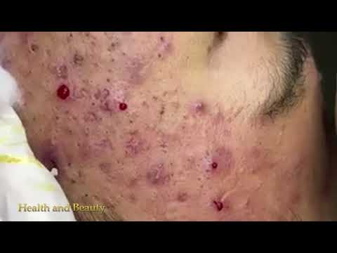 Ance Remove - Blackheads Removal - Best Pimple Popping (Part 03)