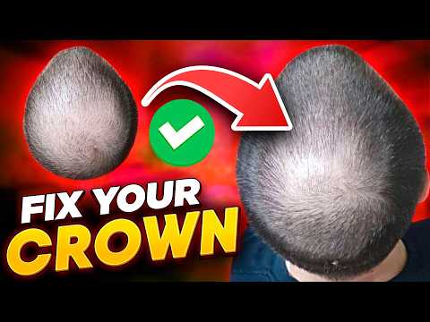 Crown Hair Loss? - Here's how to FIX a balding crown area