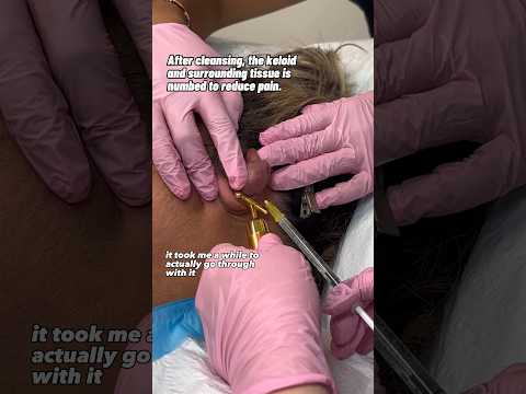 Keloid Removal! #keloid #dermatology #removal