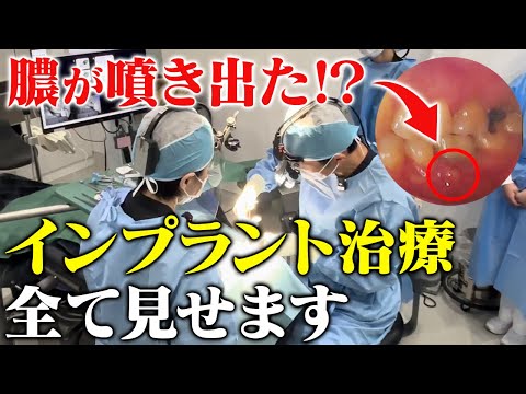 歯医者が怖い患者をインプラントで救う【歯科恐怖症】