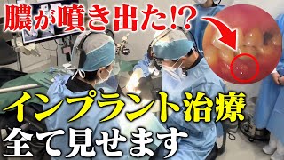 歯医者が怖い患者をインプラントで救う【歯科恐怖症】