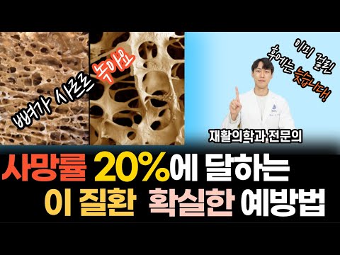 사망률 무려 20%에 달하는 뼈가 사르르 녹는 질환 | 골다공증을 예방하는 확실한 방법!